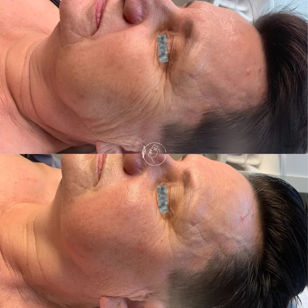 Efekt terapii anti-aging na policzek i okolice oka przed i po